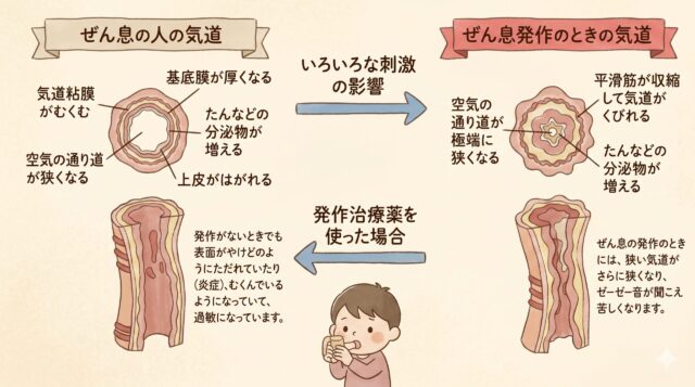 「気管支喘息ってそもそもどんな病気？」のイメージイラスト